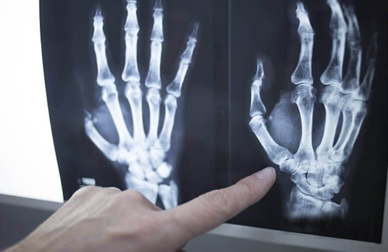radiographie des mains